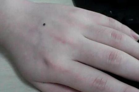 手心的痣相解析：它们可能暗示了什么人生特征