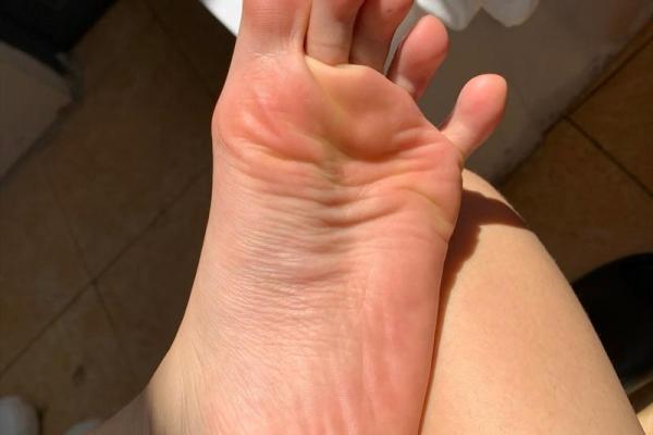 如何通过脚底痣相分析你的性格