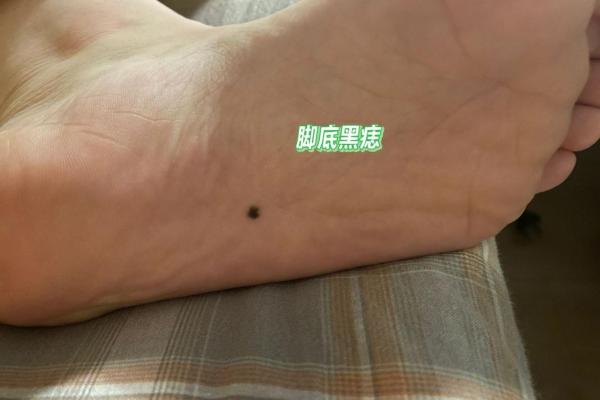 破解痣相学：它只是迷信还是有一定道理？