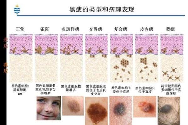 女性面部痣相中的吉凶痣：哪些痣代表好运，哪些需警惕