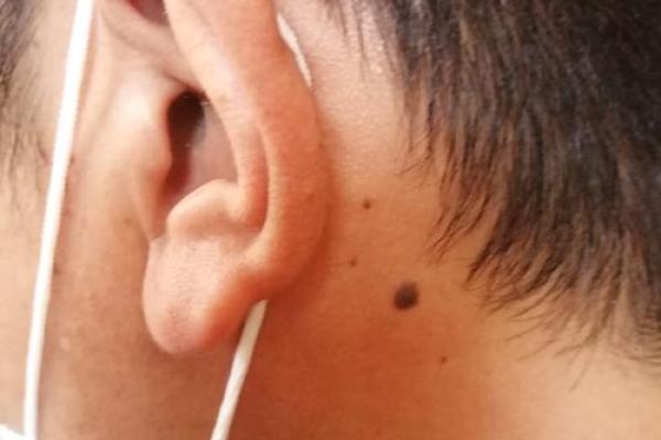 解密痣相：相书中的痣与人生运势之间的秘密