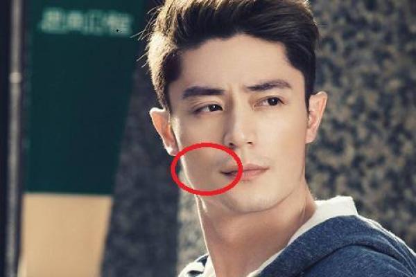 头部长痣代表什么？解析头顶痣相的不同类型