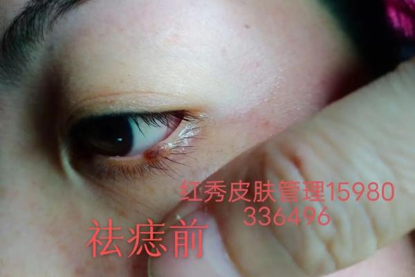如何通过幼儿痣相预测孩子的健康和命运