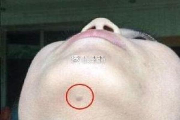 如何通过痣相辨别杀子运势