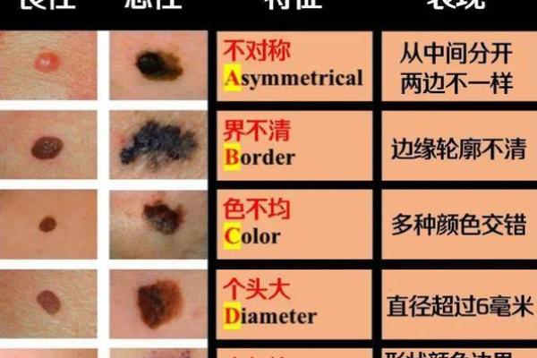探索痣相表：从身体痣的分布看个人运势