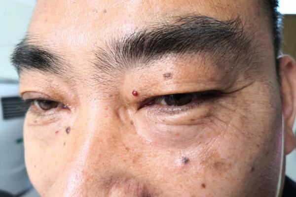 项痣相解析：如何通过项部痣相判断性格与运势