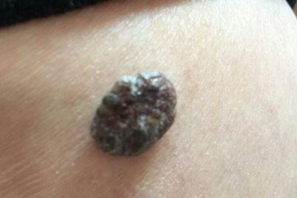 鸡鸡痣相：揭秘痣的位置与命运的神秘关联