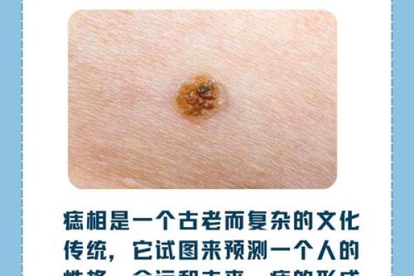 女人身上有痣的秘密：痣的位置和形态解读命运走向