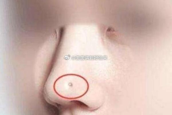 右脸痣与财富运势的潜在关系