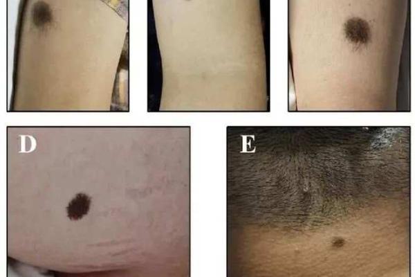 痣相迷信的误区与现实：科学与传统的碰撞