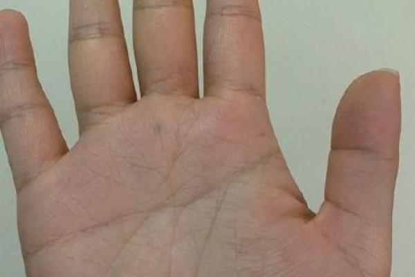 医学手相学：手掌线条背后的疾病预警信号