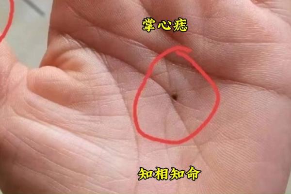 手心的痣代表什么？看看它如何影响你的命运