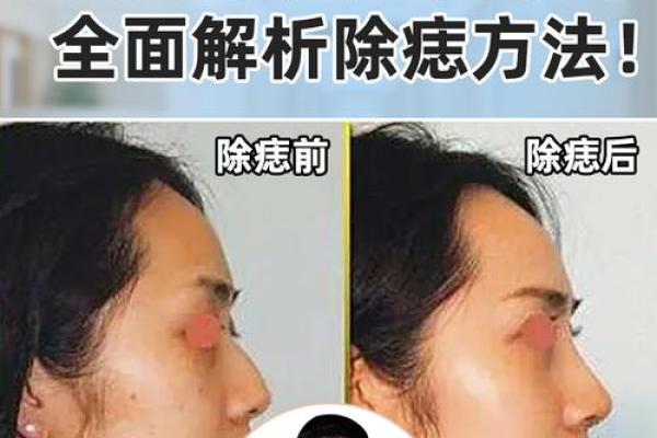探索痣在相征中的深层文化解读