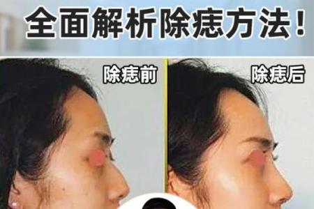 探索痣在相征中的深层文化解读