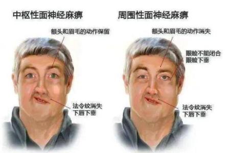 歪嘴面相解读：如何从面相看出性格特点