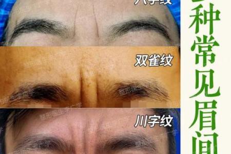 去除眉间八字纹的有效方法与护肤技巧