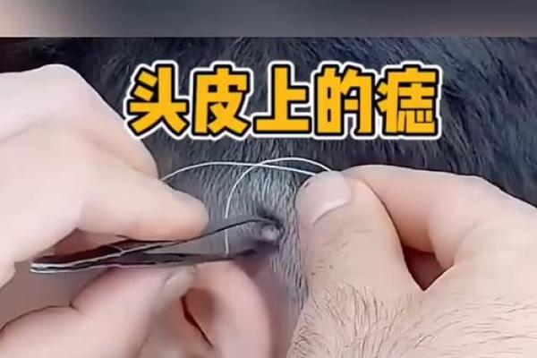 头发里的神秘符号：揭秘头部痣相的神秘力量