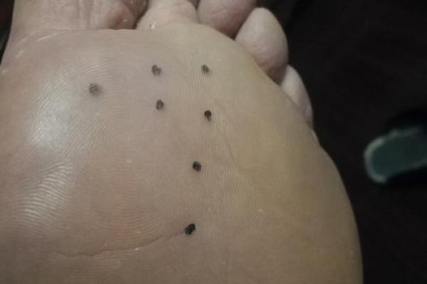 脚底痣相运势揭秘：你的痣相暗示了怎样的命运？