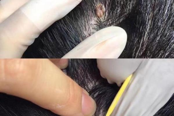 头发里的肉痣：隐藏的神秘符号