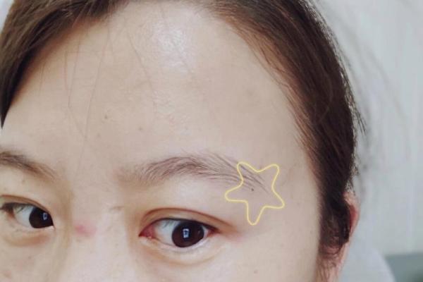眉痣之谜：揭秘眉尾痣对男人的影响
