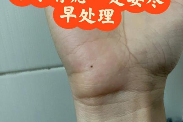 神秘右手心痣，带你探寻命运的奥秘