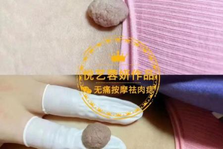 肉痣藏福，揭秘大肉痣背后的惊人秘密