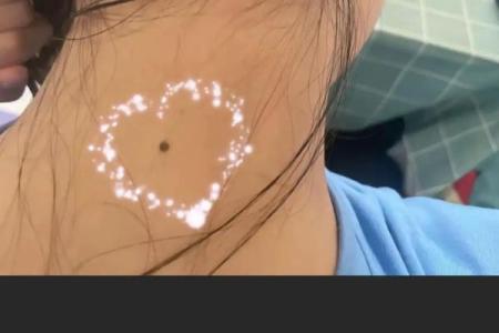 美丽与运势并存：脖子上的痣，女人的独特魅力
