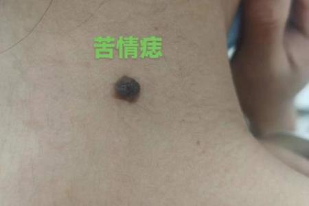 脖子上的神秘痣，命运密码大揭秘