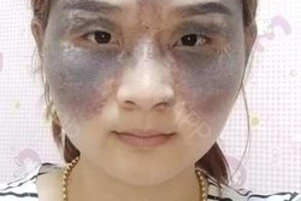 痣相与健康：科学家带你探索胎记背后的科学故事