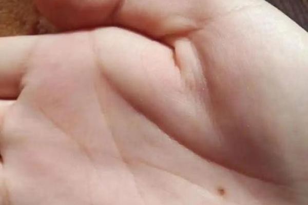 安徽相法红痣大揭秘：你的运势如何？
