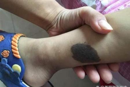 长毛黑痣，个性独特吸睛无数