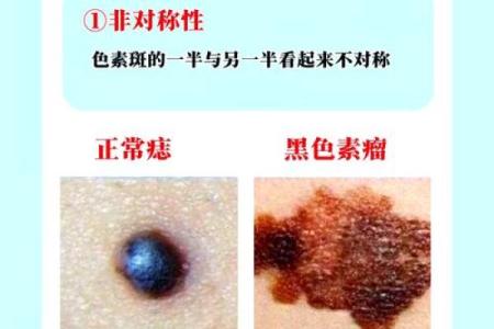 痣相预示的疾苦：揭秘那些隐藏在肌肤下的健康危机