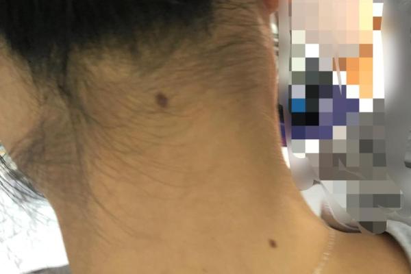 婚姻好坏一痣定：男性痣相中的幸福密码