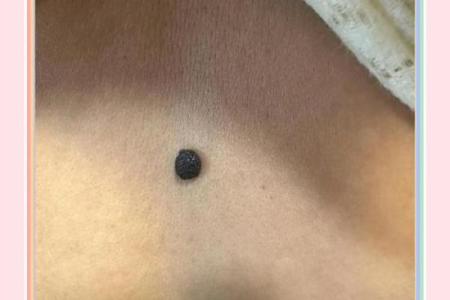 一颗痣改变一生脚大拇指痣相，看看你的运势如何