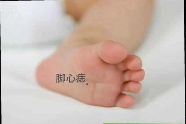 脚底颗黑痣，揭秘你的财运和健康