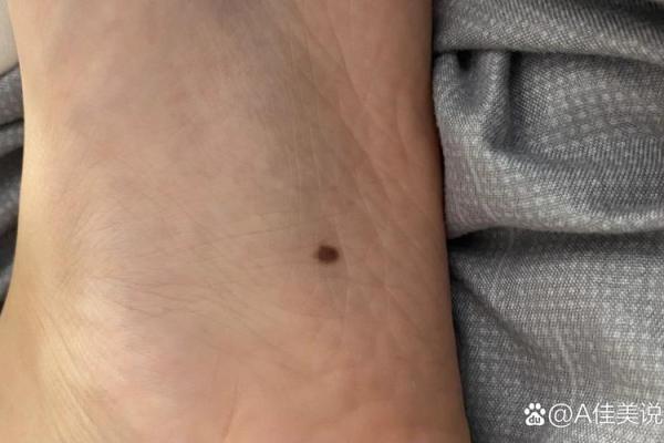 脚底痣相大揭秘：你的命运命运如何？