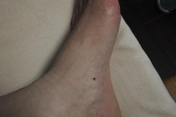 脚底痣相大揭秘：你的命运命运如何？
