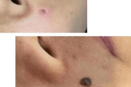 揭秘嘴唇上痣的秘密，男人魅力大增