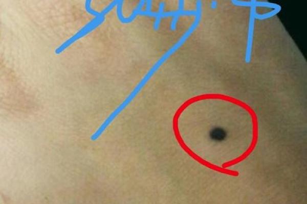 痣相算命大揭秘：手上的痣预示着什么？