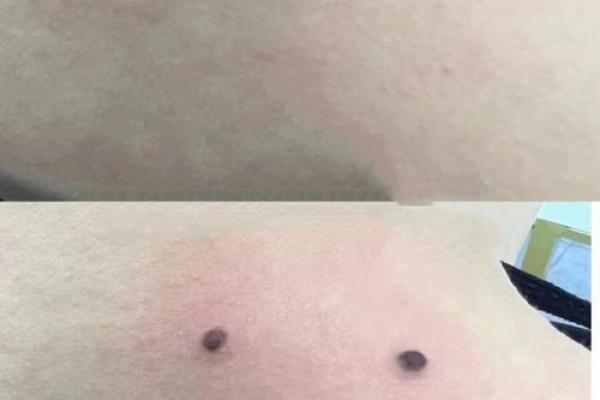 背后痣的神奇力量，你知道多少？