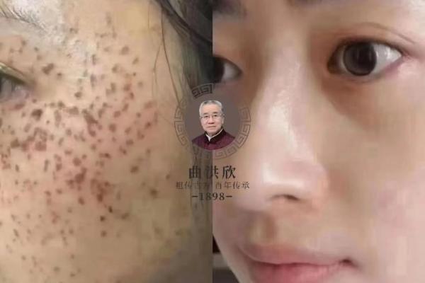 背后痣的神奇力量，你知道多少？