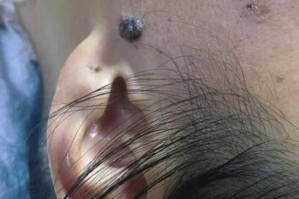 穷鬼上门的痣相解析，让你财运亨通不是梦