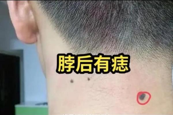 一痣定乾坤？揭秘痣相背后的秘密