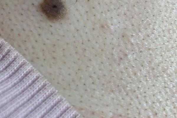 女人后背痣相解读：美丽背后隐藏的运势密码