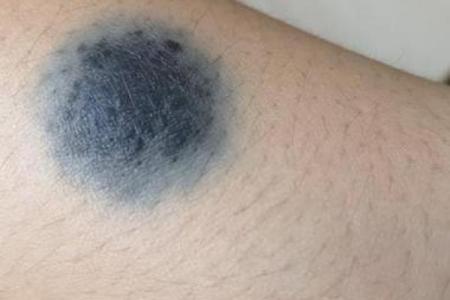 奇迹降临宝宝额头痣预示着什么？