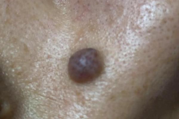 财运好坏看痣相?揭秘鼻翼痣的秘密 财运好坏看痣相?揭秘鼻翼痣的秘密