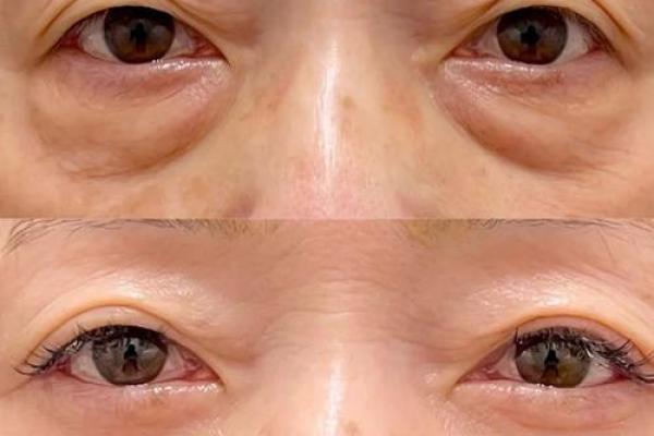 眼袋暴露运势?揭秘女子面相中的眼袋秘密 眼袋暴露运势?揭秘女子面相中的眼袋秘密