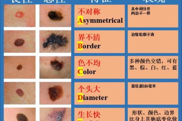 腿上痣的奥秘：预示着怎样的命运转折？