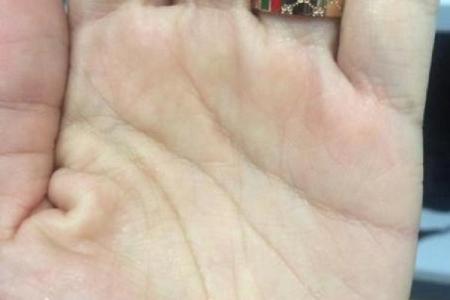 手相揭秘：一眼看穿内分泌失调的秘密