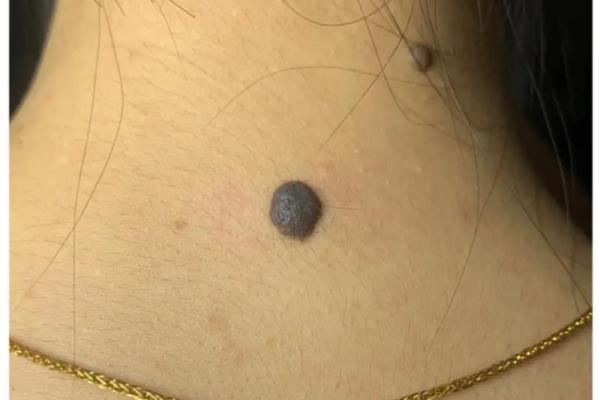 脖子上的秘密:女性相学里的痣相大全解析 脖子上的秘密:女性相学里的痣相大全解析